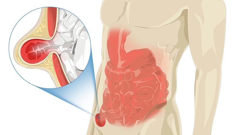 Hernia Surgery Los Angeles | Danny Shouhed, MD